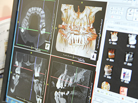 歯科用CTで正確な診査診断