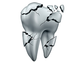 まわりの歯に悪影響をおよぼす歯は抜歯になる可能性もあります