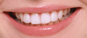 歯の黄ばみはホワイトニングで白くできる！