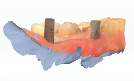 IOS（口腔内スキャナー）による印象採得