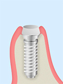 身体にかかる負担を抑えた「抜歯即時埋入インプラント」