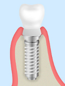身体にかかる負担を抑えた「抜歯即時埋入インプラント」