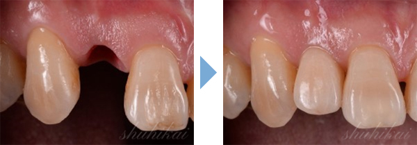 症例紹介 優ビル歯科医院の症例をご紹介します