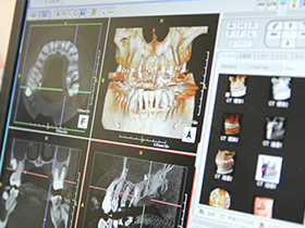 歯科用CTで親知らずの状況を見極めます