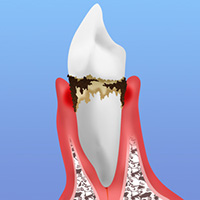 中等度歯周病
